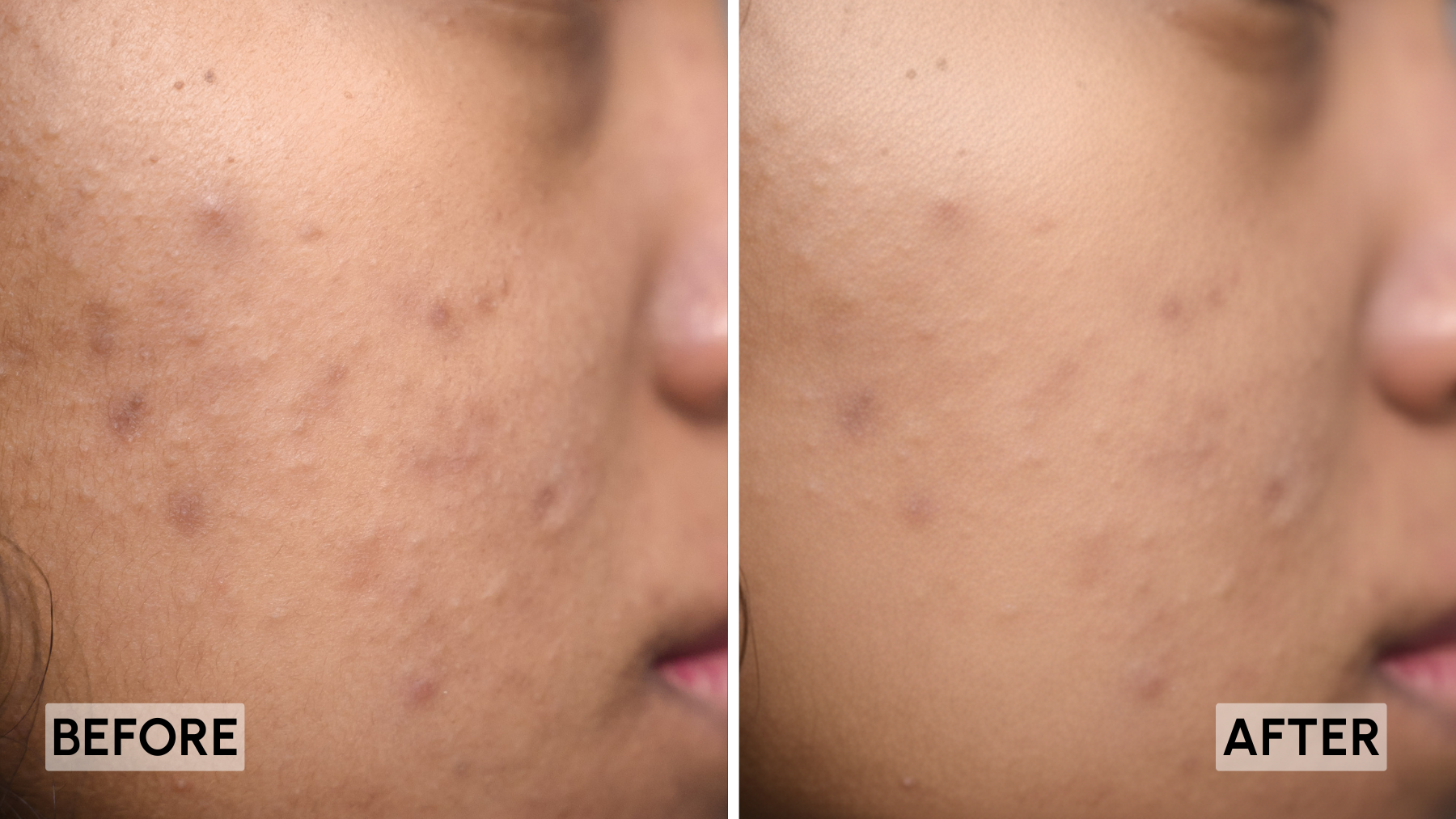 Before and after image of acne-prone skin, showing fewer visible blemishes and smoother-looking skin following LED light mask treatment.