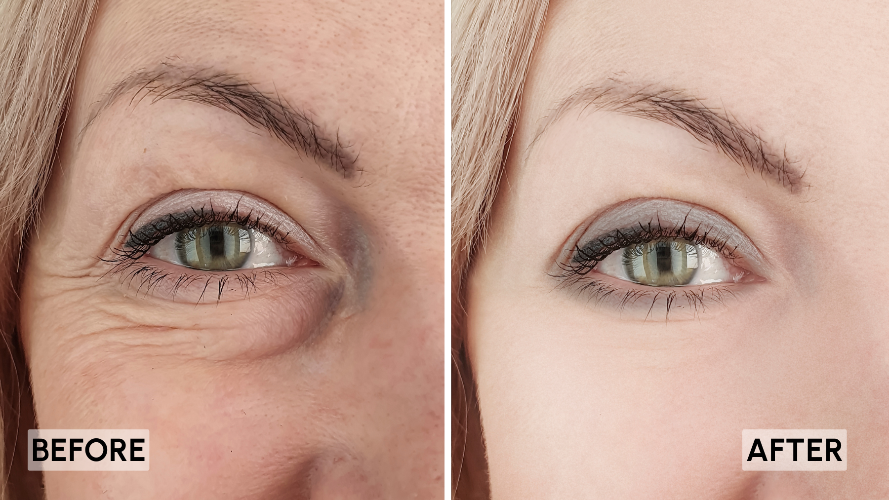 Before and after image of the eye area showing the appearance of fine lines and wrinkles before and smoother-looking skin after LED light mask use.